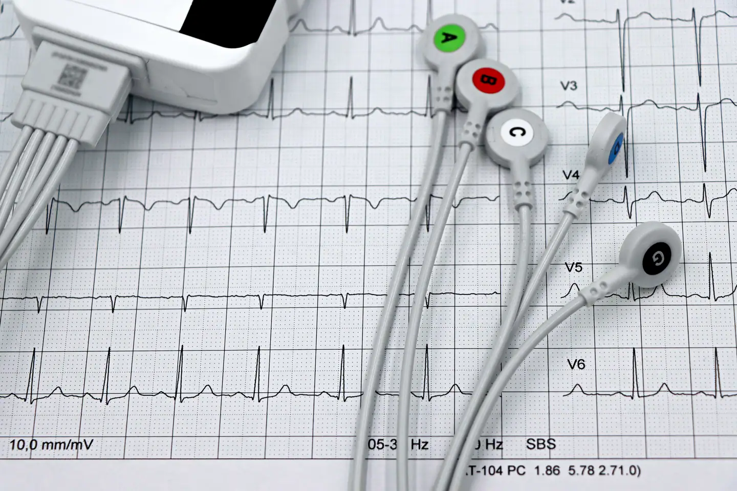 EKG-Kabel mit Klemmen auf einem ausgedruckten EKG-Streifen